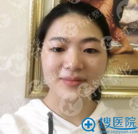 做双眼皮手术前的单眼皮照片 做双眼皮手术前的单眼皮照片