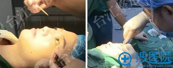福州台江双眼皮手术过程图 福州台江双眼皮手术过程图