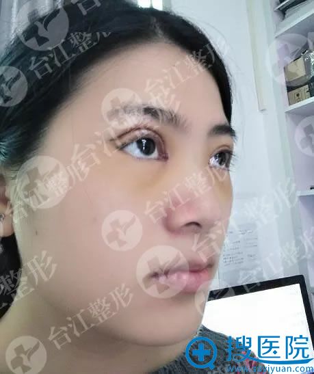 做全切双眼皮手术第1天效果 做全切双眼皮手术第1天效果