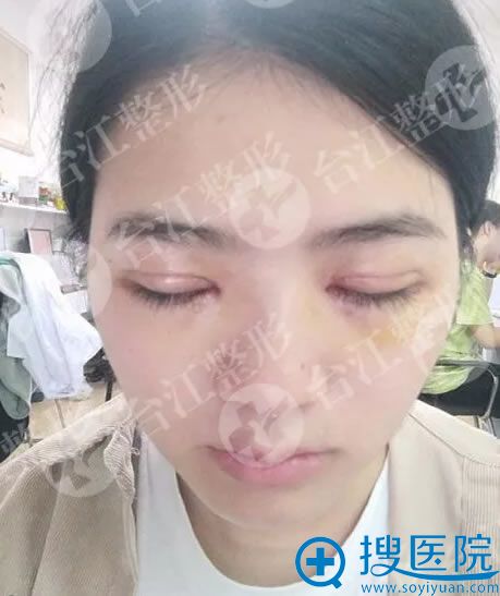 割双眼皮手术第4天疤痕恢复情况 割双眼皮手术第4天疤痕恢复情况