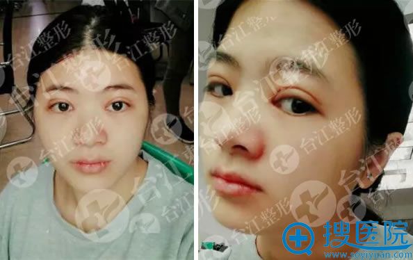 福州台江双眼皮案例第7天效果 福州台江双眼皮案例第7天效果