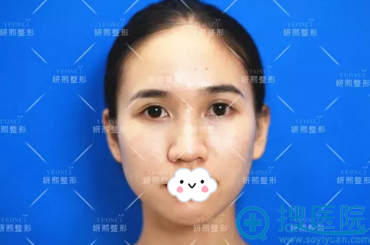 路人甲变身甜美小姐姐 深圳妍熙耳软骨隆鼻+鼻翼缩小前后对比