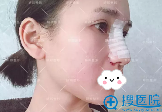 耳软骨隆鼻+鼻翼缩小术后侧脸照 耳软骨隆鼻+鼻翼缩小术后侧脸照