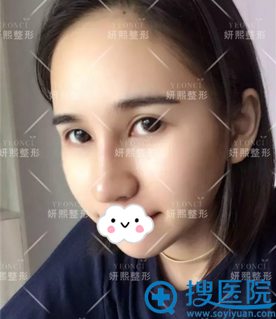 深圳妍熙假体+耳软骨垫鼻尖术后照片 深圳妍熙假体+耳软骨垫鼻尖术后照片