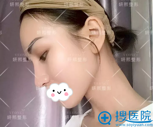 假体隆鼻术后1个月侧脸照 假体隆鼻术后1个月侧脸照