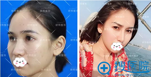深圳妍熙鼻翼缩小手术前后对比照 深圳妍熙鼻翼缩小手术前后对比照