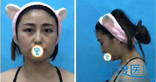 在洛阳找吸脂大王谢景良做了面部吸脂 我又重新变回小V脸了