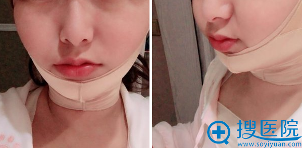 谢景良面部吸脂术后即刻 谢景良面部吸脂术后即刻
