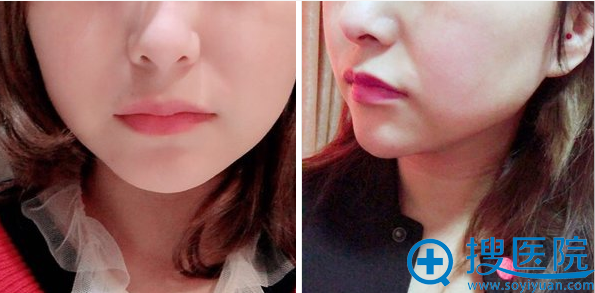 面部吸脂术后5天恢复效果 面部吸脂术后5天恢复效果