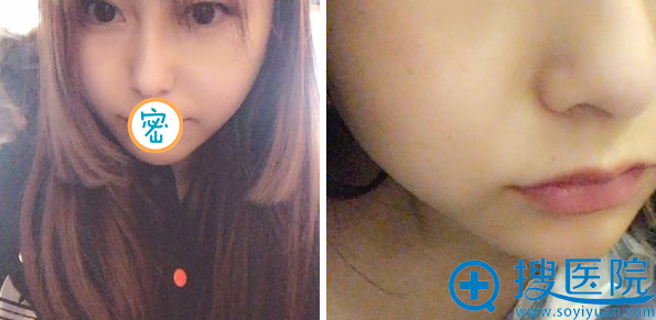 谢景良面部吸脂1个月恢复效果 谢景良面部吸脂1个月恢复效果