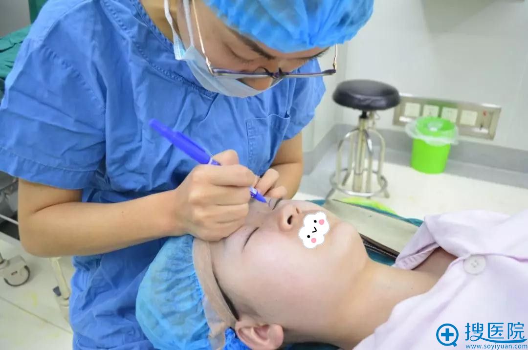 江苏施尔美孙欣做双眼皮术前画线 江苏施尔美孙欣做双眼皮术前画线