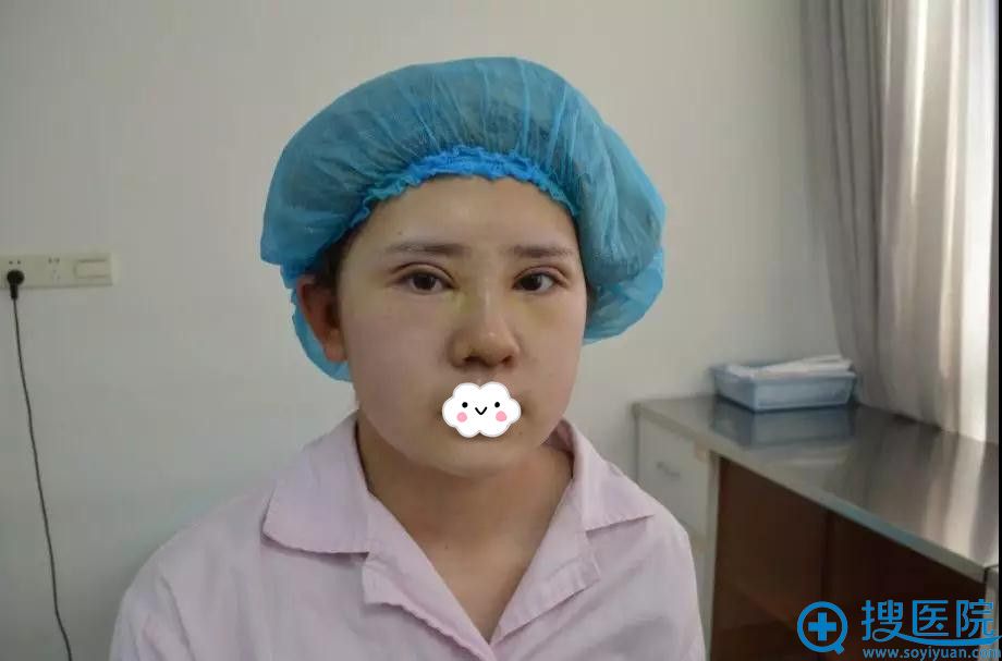 江苏施尔美双眼皮+隆鼻术后6天效果 江苏施尔美双眼皮+隆鼻术后6天效果