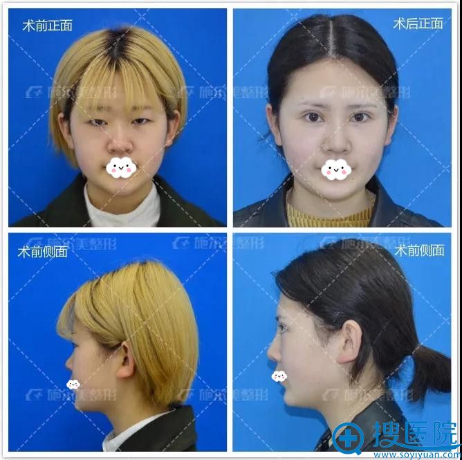 江苏施尔美双眼皮+隆鼻术前术后恢复效果对比 江苏施尔美双眼皮+隆鼻术前术后恢复效果对比