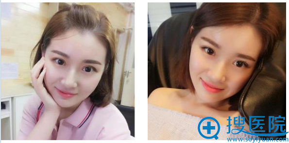 济南历下美莱韩旭双眼皮1个月效果图 济南历下美莱韩旭双眼皮1个月效果图