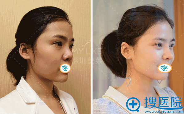 深圳美莱梁晓健达拉斯隆鼻术后对比照 深圳美莱梁晓健达拉斯隆鼻术后对比照