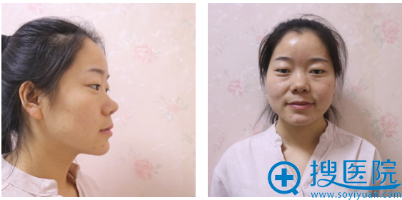 这是璇子找济南历下美莱韩旭做的双眼皮隆鼻和脂肪填充案例