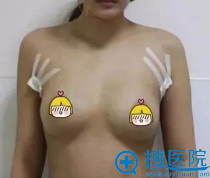 江门福康假体隆胸手术即刻效果图 江门福康假体隆胸手术即刻效果图