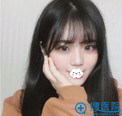 看江苏南京施尔美玻尿酸丰卧蚕案例30天后眼睛变得萌动水灵
