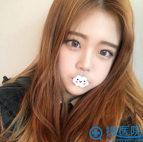 南京施尔美玻尿酸填充卧蚕术后15天 南京施尔美玻尿酸填充卧蚕术后15天