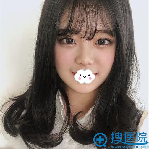 南京施尔美玻尿酸填充卧蚕术后22天案例 南京施尔美玻尿酸填充卧蚕术后22天案例