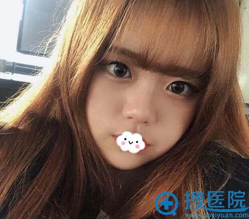 南京施尔美玻尿酸填充卧蚕术后一个月 南京施尔美玻尿酸填充卧蚕术后一个月