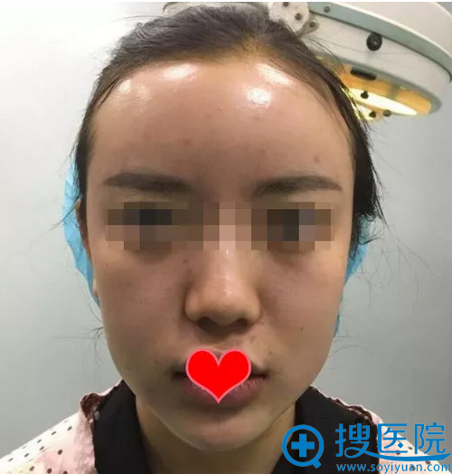 脂肪填充额头+假体丰下巴术后即刻效果 脂肪填充额头+假体丰下巴术后即刻效果