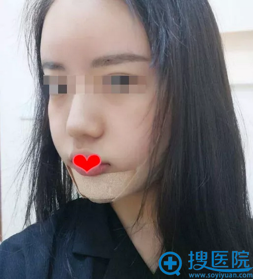 东莞美立方假体丰下巴术后1天 东莞美立方假体丰下巴术后1天