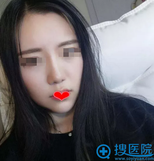 面部脂肪填充术后半个月恢复照 面部脂肪填充术后半个月恢复照