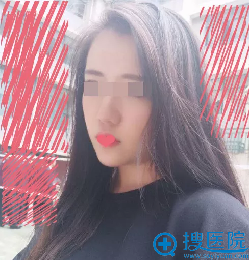 东莞美立方脂肪填充额头+丰下巴术后效果 东莞美立方脂肪填充额头+丰下巴术后效果