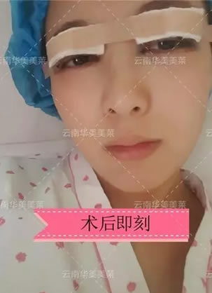 找曲靖口碑好的华美美莱整形夏国兴院长做双眼皮原生美眼效果