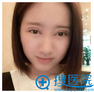 杭州雷中元双眼皮案例第二天效果图 杭州雷中元双眼皮案例第二天效果图