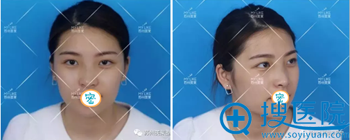 在苏州美莱整形美容医院做了线雕隆鼻 术后对比照分享