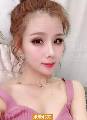 在义乌连天美做自体脂肪填充法令纹后次po照 看效果如何