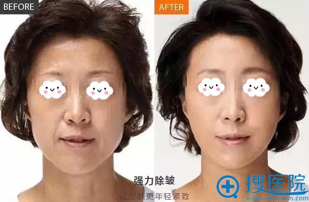 <!--<i data=20240710 data-id=12590></i>-->玻尿酸祛除皱纹案例 <!--<i data=20240710 data-id=12590></i>-->玻尿酸祛除皱纹案例