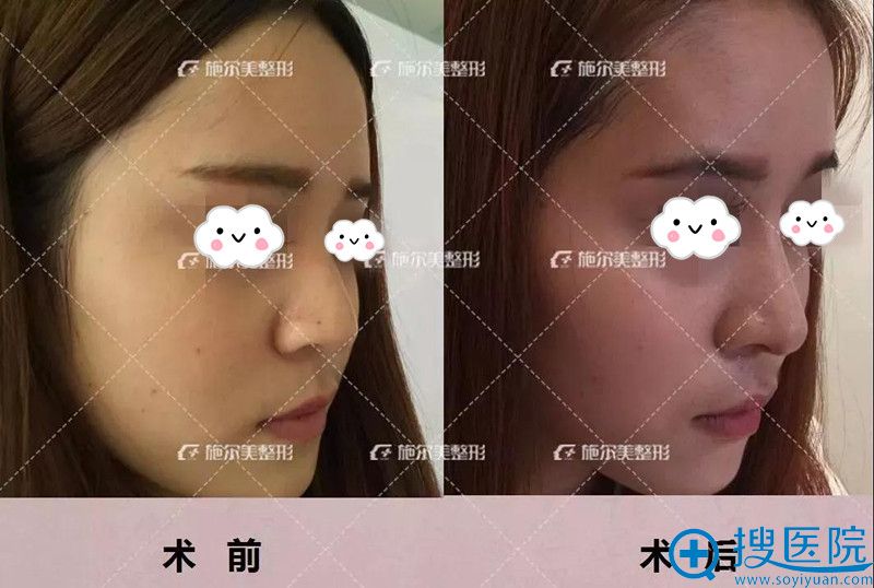江苏南京施尔美美鼻周隆鼻特惠 招募鼻整形巡讲案例20名全免费