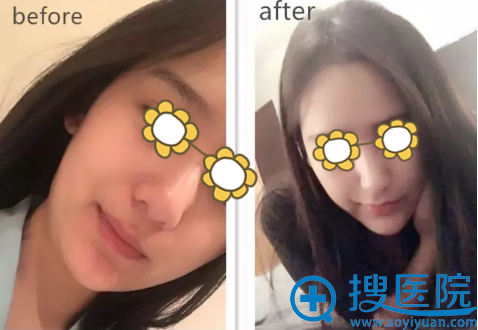 为了让讨厌的双下巴消失 我在宁波薇琳做了面部吸脂手术