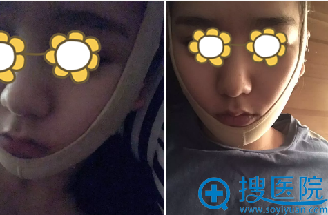 面部双下巴吸脂术后即刻 面部双下巴吸脂术后即刻