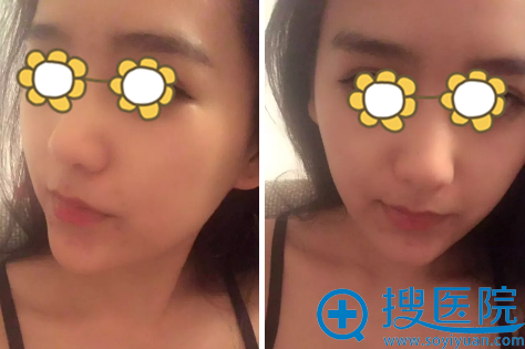 宁波薇琳面部吸脂术后10天恢复效果 宁波薇琳面部吸脂术后10天恢复效果