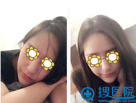 宁波薇琳下巴吸脂术后20天效果 宁波薇琳下巴吸脂术后20天效果