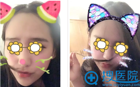 宁波薇琳医美做完面部吸脂一个多月 宁波薇琳医美做完面部吸脂一个多月