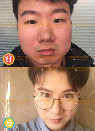 北京丽星整形医院魏志香做假体垫下巴和手术效果怎么样