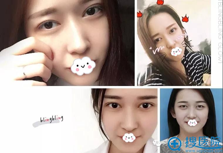 河南巩义恒颜医疗整形美容双眼皮案例 河南巩义恒颜医疗整形美容双眼皮案例