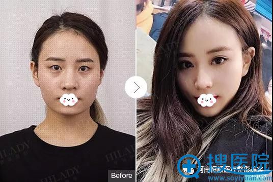 河南恒颜医疗整形美容双眼皮前后对比 河南恒颜医疗整形美容双眼皮前后对比