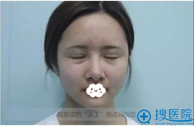 河南恒颜整形提醒:双眼皮失败案例,痕迹太明显 河南恒颜整形提醒:双眼皮失败案例,痕迹太明显