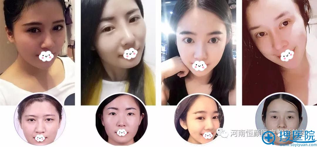 河南恒颜真人双眼皮案例对比 河南恒颜真人双眼皮案例对比