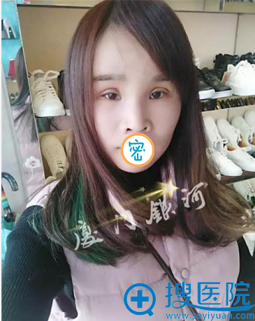 <!--<i data=20240710 data-id=12240></i>-->脂肪填充全面部3周 <!--<i data=20240710 data-id=12240></i>-->脂肪填充全面部3周