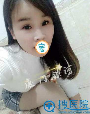 <!--<i data=20240710 data-id=12240></i>-->脂肪填充面部术后效果 <!--<i data=20240710 data-id=12240></i>-->脂肪填充面部术后效果