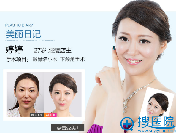 <!--<i data=20240710 data-id=12465></i>-->洪性范做的颧骨缩小和下颌角改脸型<span style= <!--<i data=20240710 data-id=12465></i>-->洪性范做的颧骨缩小和下颌角改脸型<span style=