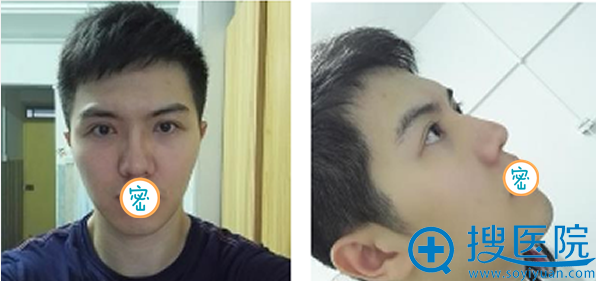 全面部脂肪填充术前照片 全面部脂肪填充术前照片