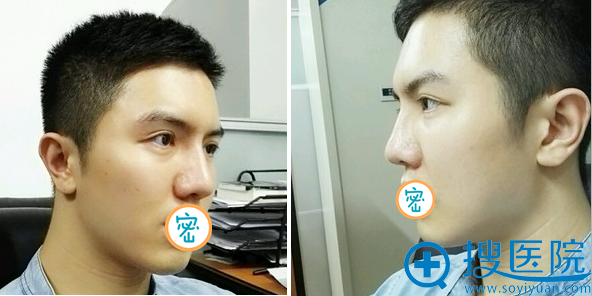 术后一个月吸脂基本不再吸收 术后一个月吸脂基本不再吸收